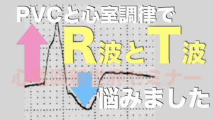 PVCと心室調律で一回悩みました。