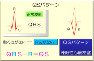 QRS-R=QS