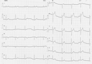 心電図のR波の成り立ち 心電図のR波の成り立ち