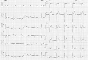 心電図のR波の成り立ち 心電図のR波の成り立ち
