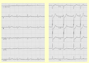 12誘導心電図と左心室壁との関係 12誘導心電図と左心室壁との関係
