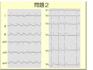 12誘導心電図と左心室壁との関係 12誘導心電図と左心室壁との関係