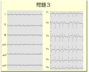 12誘導心電図と左心室壁との関係