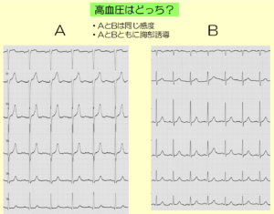 QRSのR波の意味 QRSのR波の意味