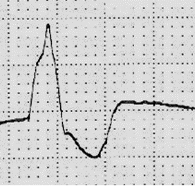 PVC（心室性期外収縮）のスコトーマ