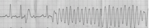 心電図波形PQRST,不安定なT波